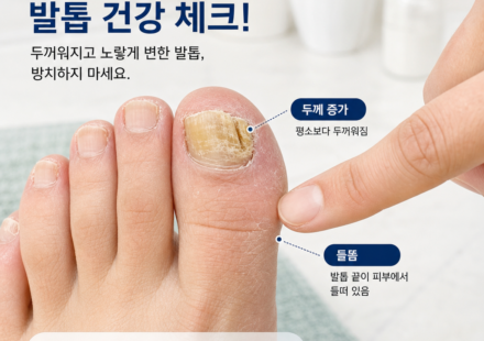 노랗게 변색되고 두꺼워진 엄지발톱을 손가락으로 가리키며 두께 증가와 들뜸 증상을 확인하는 모습