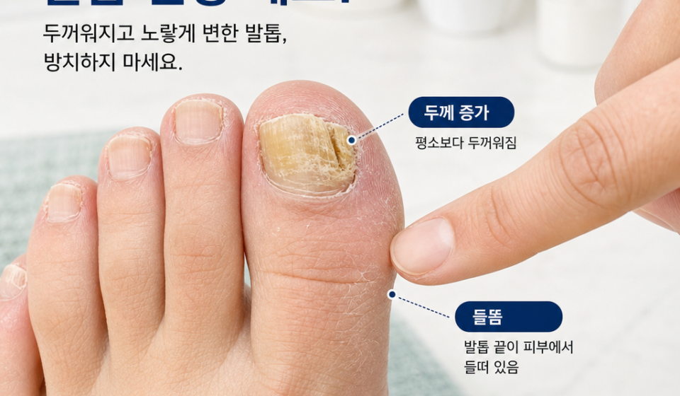 노랗게 변색되고 두꺼워진 엄지발톱을 손가락으로 가리키며 두께 증가와 들뜸 증상을 확인하는 모습